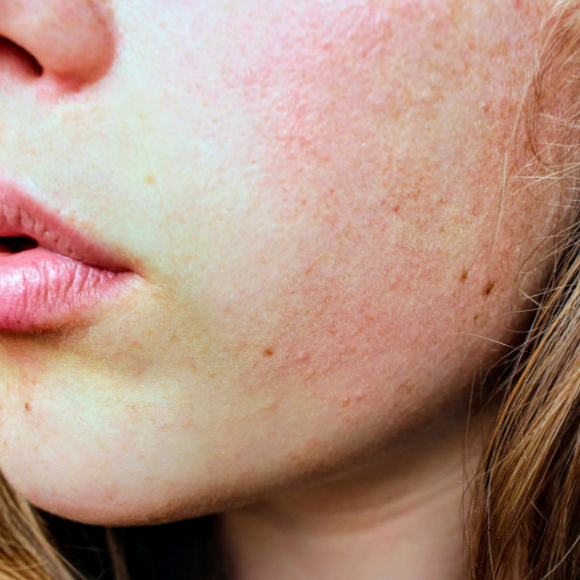 Close up of woman's face with red, irritated skin