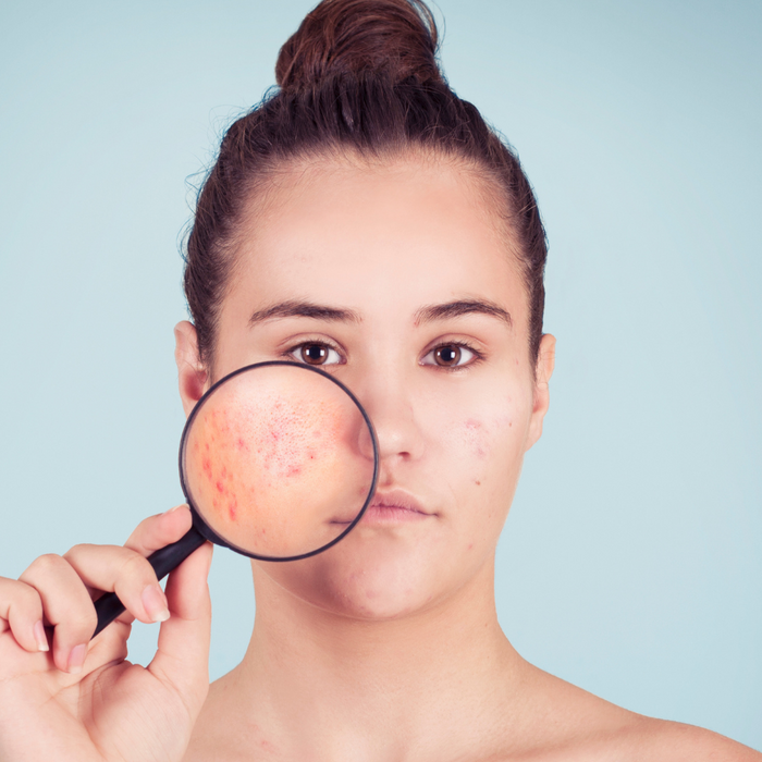 Teen girl holding magnifying glass up to face showing acne spots.